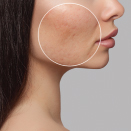 Dermatologist Acne Prevention Tips