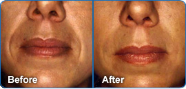 Dermal fillers before and after photos of woman's nose and mouth