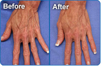 Photos of before and after hand rejuvination therapy