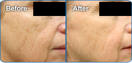 Photos of before and after using Foto Facial