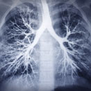 Screening for Lung Cancer in Smokers and Non-Smokers