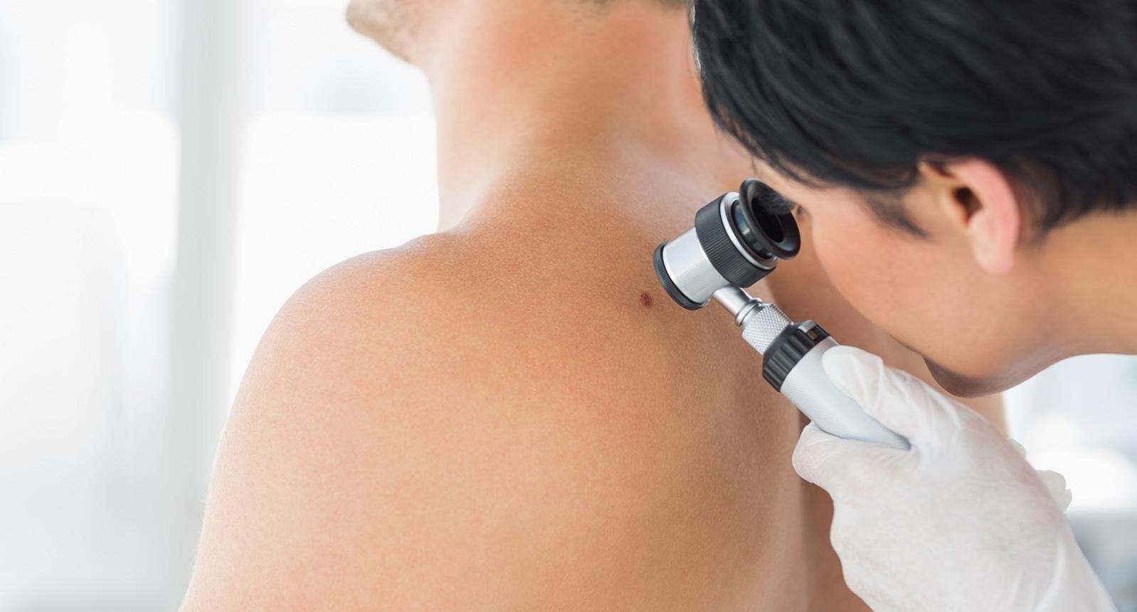 Doctor examining patient skin moles with dermoscope