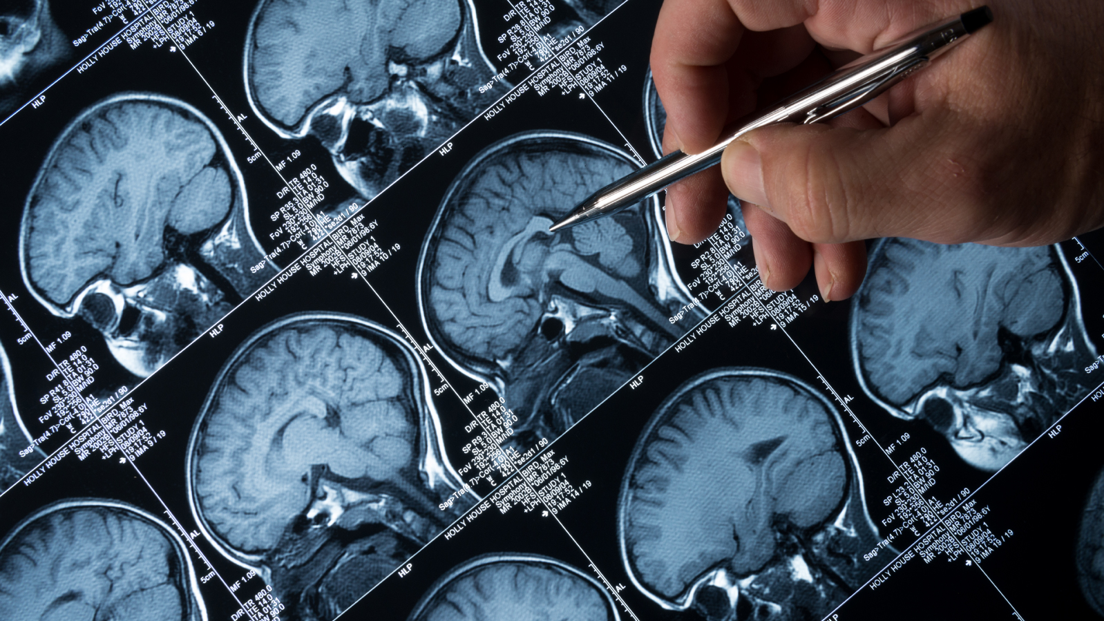 Steps to Help Reduce the Risk of Alzheimer's Disease