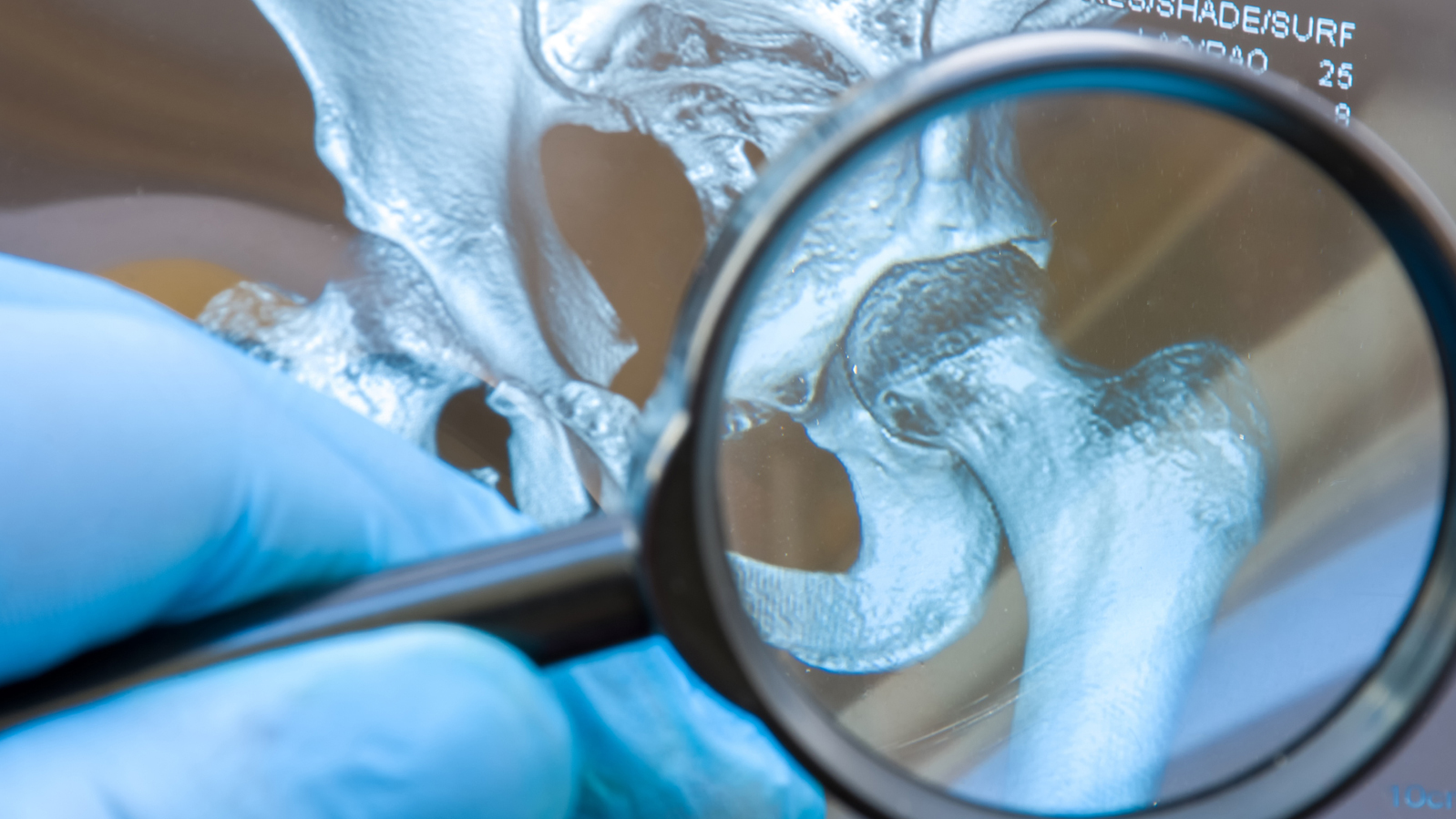 The Silent Bone Disease: What You Should Know About Osteoporosis