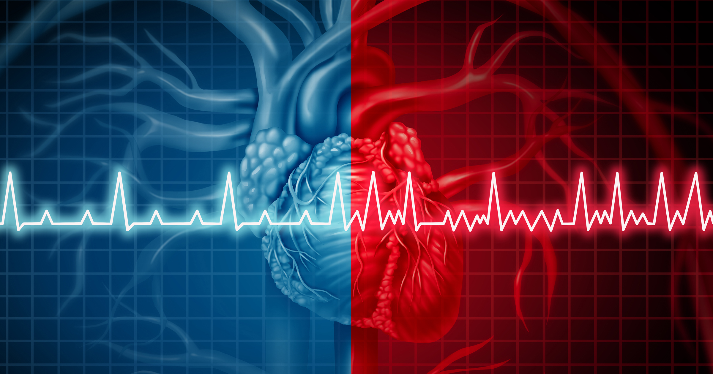 Omega-3 Fatty Acid Supplementation and Atrial Fibrillation (AFib) Risk
